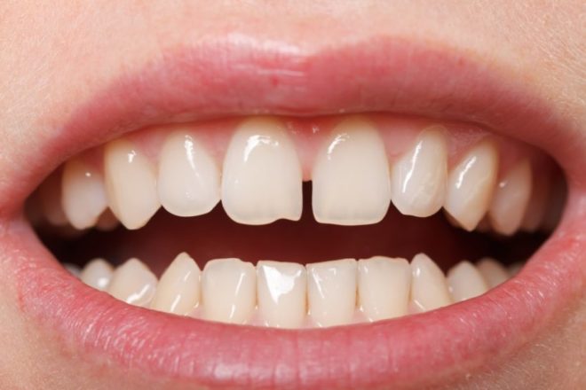 Щербинка между зубами: народные приметы и их значение
